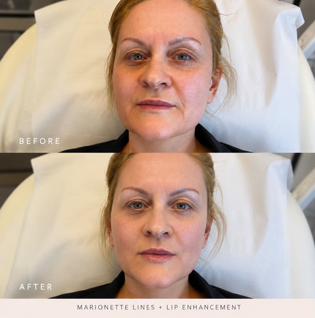 Before and after marionette line and lip enhancement treatment